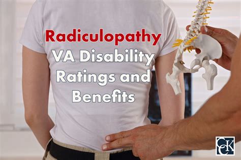 The <b>VA</b> uses specific criteria to determine the <b>rating</b> that the Veteran will receive for <b>radiculopathy</b>. . Radiculopathy va rating